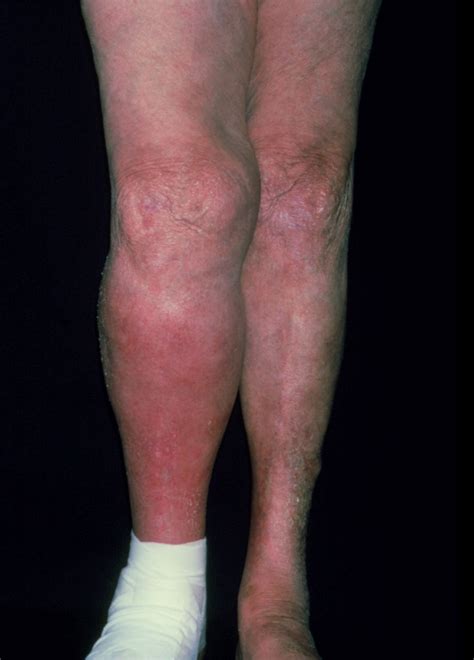 Healthy Habits to. . Dvt skin rash pictures